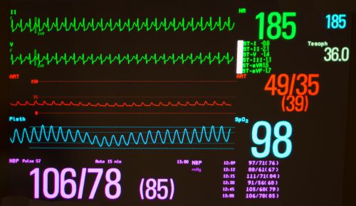 Лечение нарушений сердечного ритма (аритмий) в СПб больнице РАН, прием кардиолога