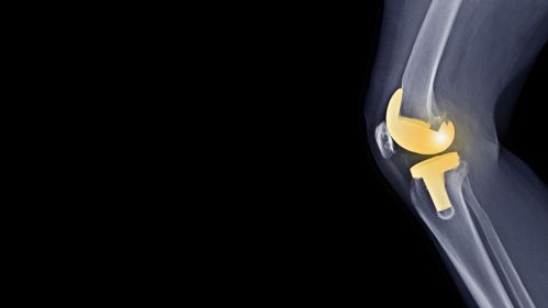 knee joint replacement 