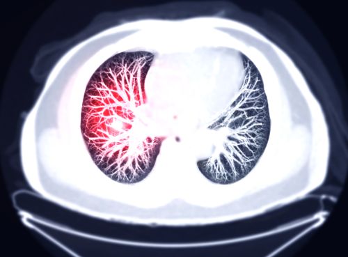 lung cancer stereotactic surgery 