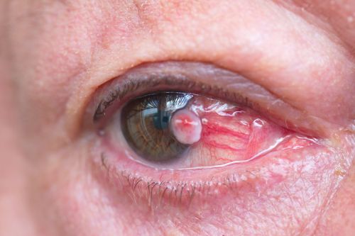 протонная терапия меланома глаза