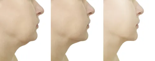 нетравматичный лифтинг в европе