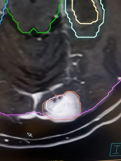 радиотерапия контурирнг
