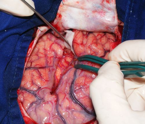 brain surgery France 