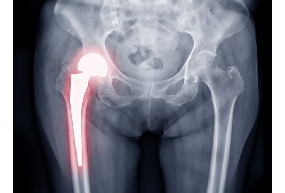 La prothèse de hanche en France
