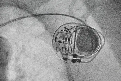 пейсмейкер протез Европа