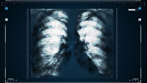 метастазы в лёгких